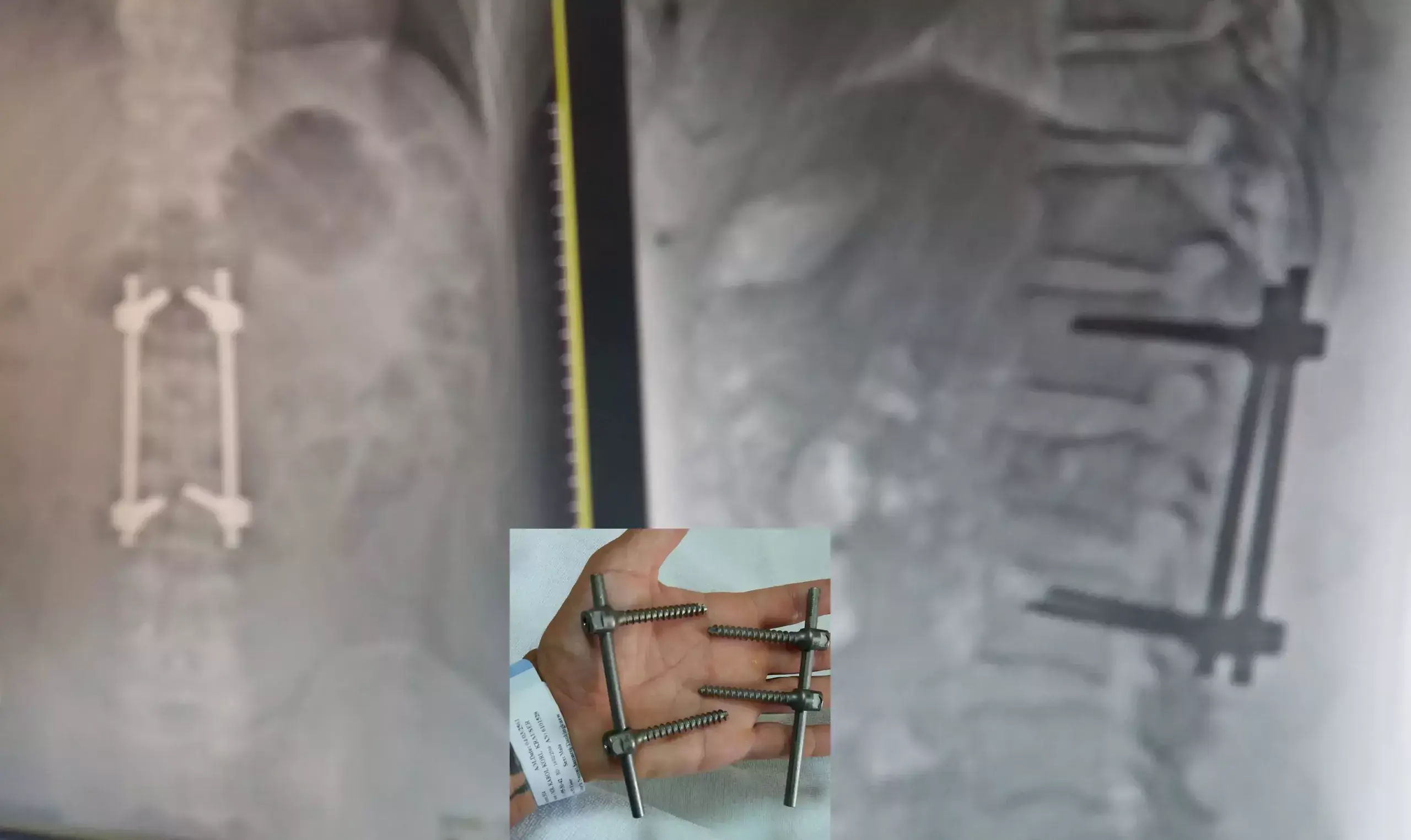 X-ray showing spine surgery and recovery